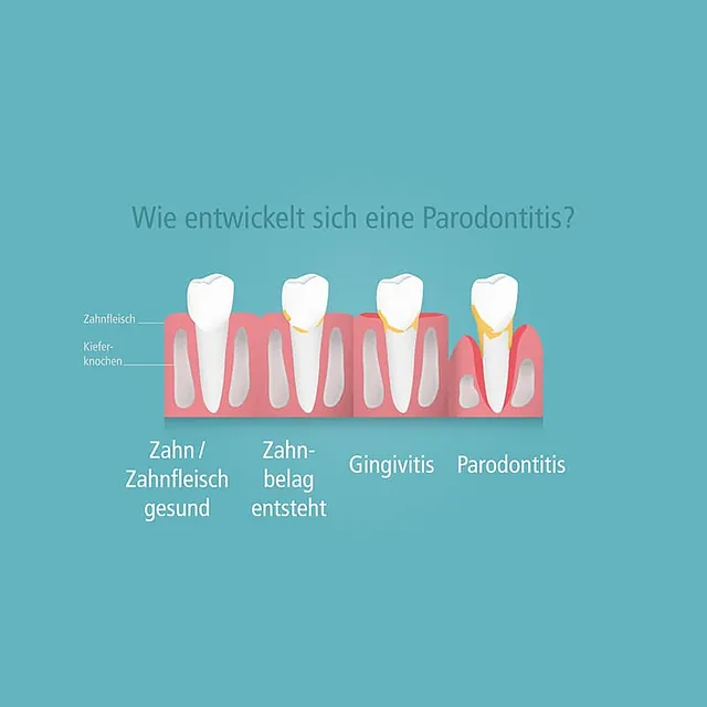 Infobild Parodontitis